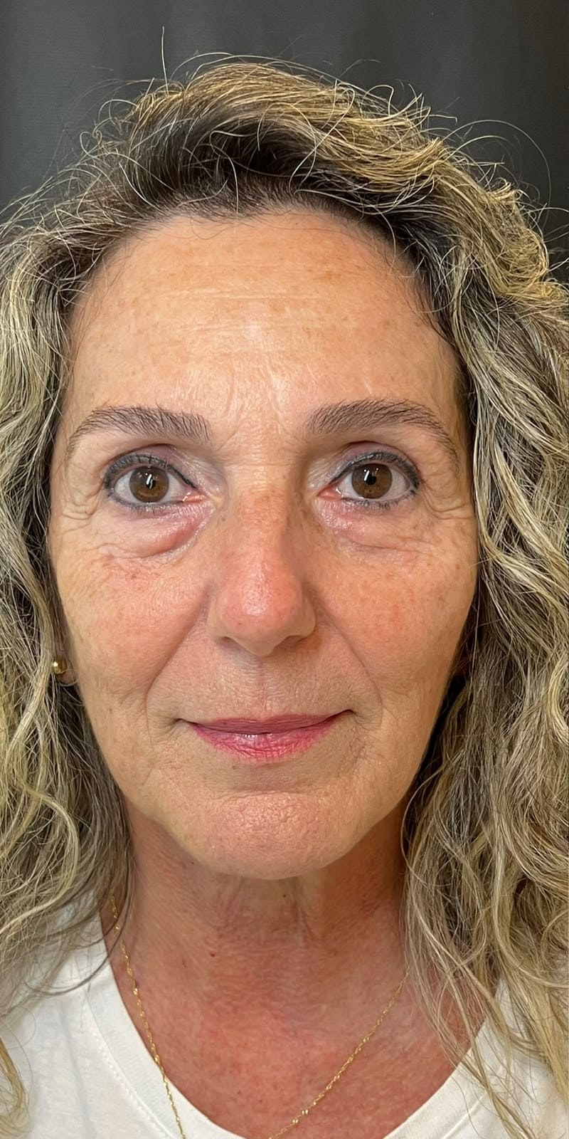 Antes — Full Face com foco em sustentação e contorno