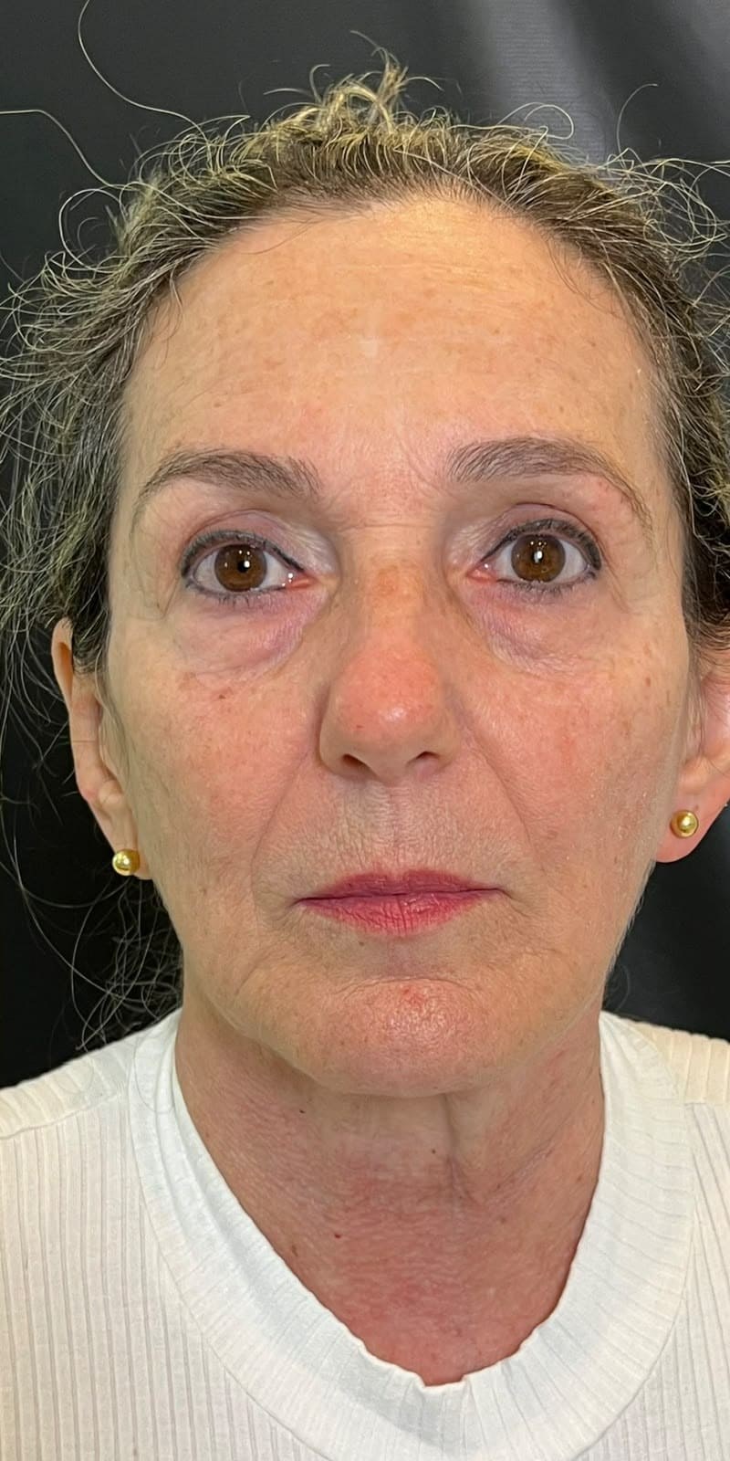 Depois — Full Face com foco em sustentação e contorno