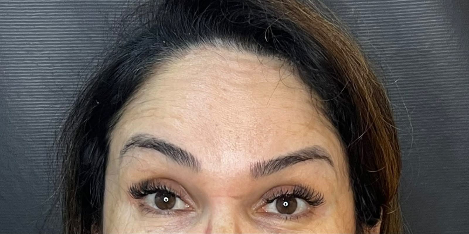 Antes — Rejuvenescimento do olhar