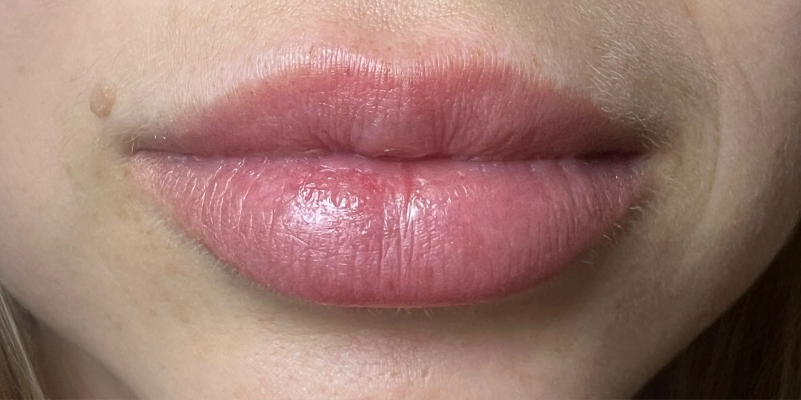 Antes — Preenchimento labial