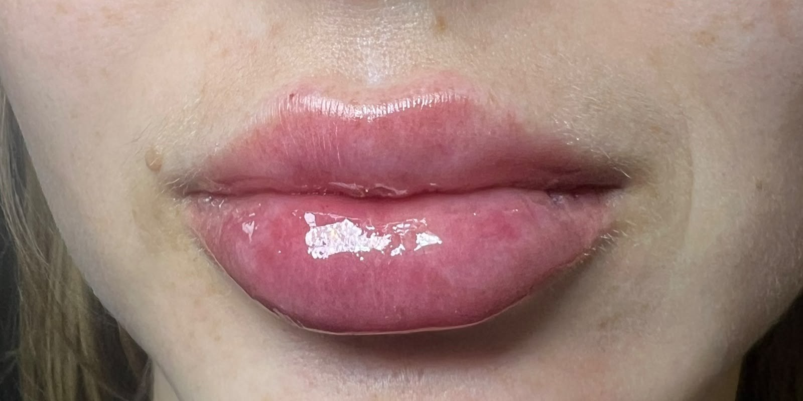 Depois — Preenchimento labial