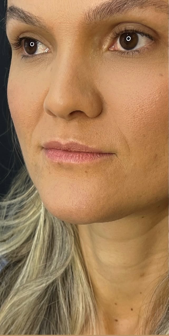 Antes — Contorno labial e definição