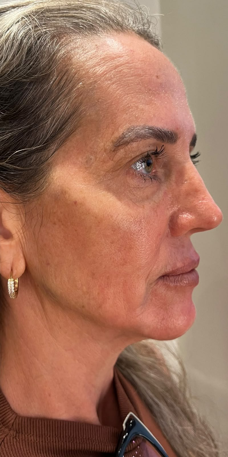 Depois — Lifting e sustentação do perfil